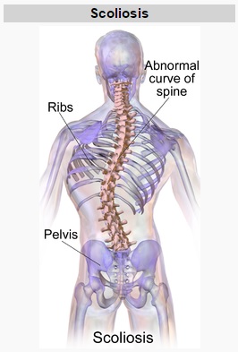 Exploring 3 Different Forms of Spine Curvature Disorders